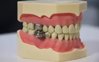 Công cụ “khóa hàm” chống béo phì kỳ lạ được thử nghiệm
