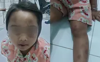 Bé gái 6 tuổi bị vợ chồng cô ruột bạo hành