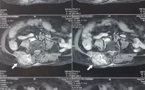 Ngại đến viện mùa dịch, cụ bà gặp biến chứng nặng sau khi điều trị tại phòng khám tư