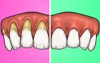 4 dấu hiệu cho thấy bạn đang đánh răng sai cách