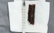 Trượt chân ngã khi đi rừng, bệnh nhân bị cành cây khô đâm vào mắt