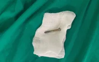Gắp đinh vít dài 5cm trong tá tràng bệnh nhi 7 tuổi