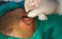 Bé trai bị chó nhà hàng xóm cắn gần đứt lìa tai