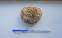 Phẫu thuật lấy sỏi kích thước 9cm trong bàng quang bệnh nhân