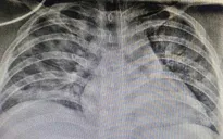 Thêm 1 trẻ béo phì mắc COVID-19 nguy kịch được cứu sống