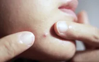 5 loại nguyên liệu hàng đầu có khả năng đánh bay mụn hiệu quả