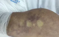 Cảnh báo một trường hợp nhiễm liên cầu lợn tiên lượng xấu