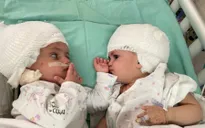 Israel tách thành công cặp song sinh dính liền đầu sau ca phẫu thuật kéo dài 12 giờ