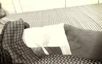 Nhiễm trùng vết bỏng nặng do tự đắp thuốc nam điều trị tại nhà
