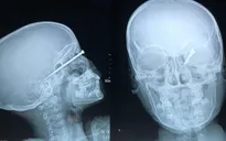 Đi săn chuột ban đêm, bé trai bị mũi tên bắn xuyên nhãn cầu