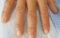Bệnh nhân bị rối loạn đông máu do hóa chất thúc ép trái cây chín nhanh