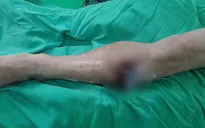 Bị lưỡi cày găm vào chân khi đang cày ruộng