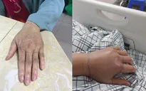 Cứu sống kịp thời người bệnh bị rắn lục cắn