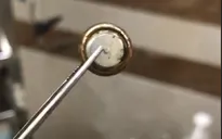 Bé trai suýt hoại tử mũi vì pin cúc áo