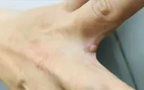 Đắk Lắk: Phát hiện một trường hợp trở về từ Nam Phi nghi mắc đậu mùa khỉ