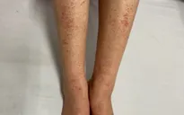 Cẩn trọng với sốt xuất huyết Dengue