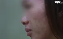 Nhiễm trùng nặng vì chăm sóc da tại spa trôi nổi