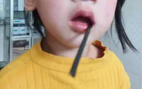 Chạy chơi bị ngã, bé gái bị thanh sắt khoảng 20cm đâm vào khoang miệng