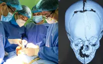Phẫu thuật tạo hình cho bé sơ sinh 17 ngày tuổi có khe hở sọ mặt phức tạp rất hiếm gặp