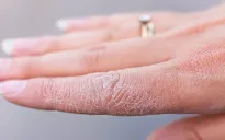 Làm thế nào để chăm sóc làn da khô hiệu quả?