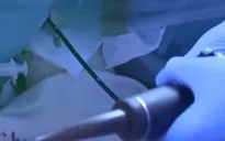 Thiết bị đầu dò 3D hỗ trợ phẫu thuật tim