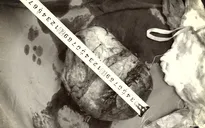 Bóc tách khối u buồng trứng nặng 2,6kg cho bệnh nhân có nhiều bệnh nền