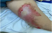 Phỏng cồn ở trẻ em: Những điều cần lưu ý