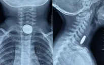 Bé 3 tuổi bị bỏng thực quản do nuốt pin cúc áo
