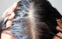 5 lý do không tưởng khiến bạn "hói" dần