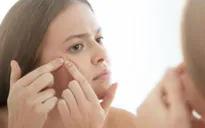 Mẹo nặn mụn hiệu quả mà không để lại thâm sẹo