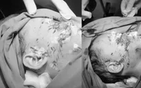 Bé 28 tháng tuổi bị chó cắn gây tổn thương nghiêm trọng vùng mặt
