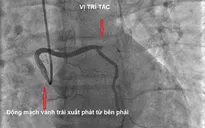 Cấp cứu bệnh nhân nhồi máu cơ tim cấp có bất thường giải phẫu động mạch vành
