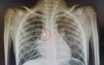 Bệnh nhi 6 tuổi nhập viện do nuốt phải pin cúc áo