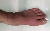 Bệnh gout: Lý do nhiều người phát bệnh hoặc bị nặng lên sau kỳ nghỉ Tết