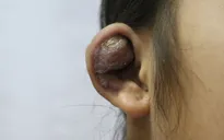 Áp xe vành sụn tai - hậu quả của việc bấm khuyên tai làm đẹp