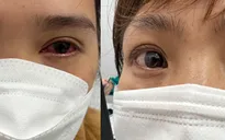 Cẩn trọng với những di chứng liên quan đến mắt hậu COVID-19