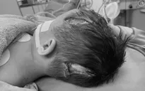Sang nhà bà chơi, bé trai bị chó tấn công lộ xương sọ