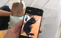 Bé gái 6 tháng tuổi bị chó nhà cắn xuyên sọ