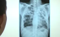 Bé gái 12 tuổi nguy kịch vì mắc vi trùng lao