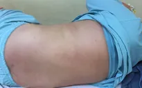 Hậu COVID-19: Bé 10 tuổi sốt cao, ho khan, nổi ban đỏ khắp cơ thể