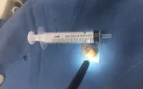 Gắp viên thuốc còn nguyên vỏ nằm trong khí quản bệnh nhân suốt 3 năm