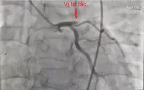 Người đàn ông ngừng tim ngoại viện do nhồi máu cơ tim cấp