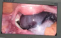 Nội soi cắt u buồng trứng xoắn và ruột thừa cho bé gái 14 tuổi