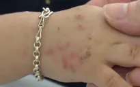 Gia tăng trẻ mắc bệnh tay chân miệng