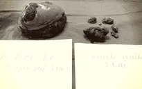 Người phụ nữ hoại tử một bên ngực vì đắp thuốc nam chữa ung thư vú