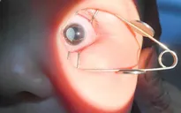 Bệnh võng mạc ở trẻ sinh non: Cần đi khám đúng hẹn, tránh nguy cơ mù loà