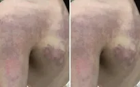 Tạm dừng đứng lớp với cô giáo đánh học sinh lớp 3 bầm tím lưng