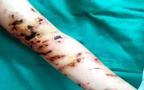 Nhiều người bị sứa đốt phải nhập viện sau khi đi biển