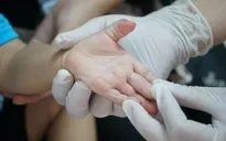 Cảnh báo số trẻ mắc tay chân miệng ở Hà Nội tăng vọt