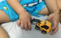 TP Hồ Chí Minh: Nguy cơ "dịch chồng dịch" từ bệnh sốt xuất huyết và tay chân miệng